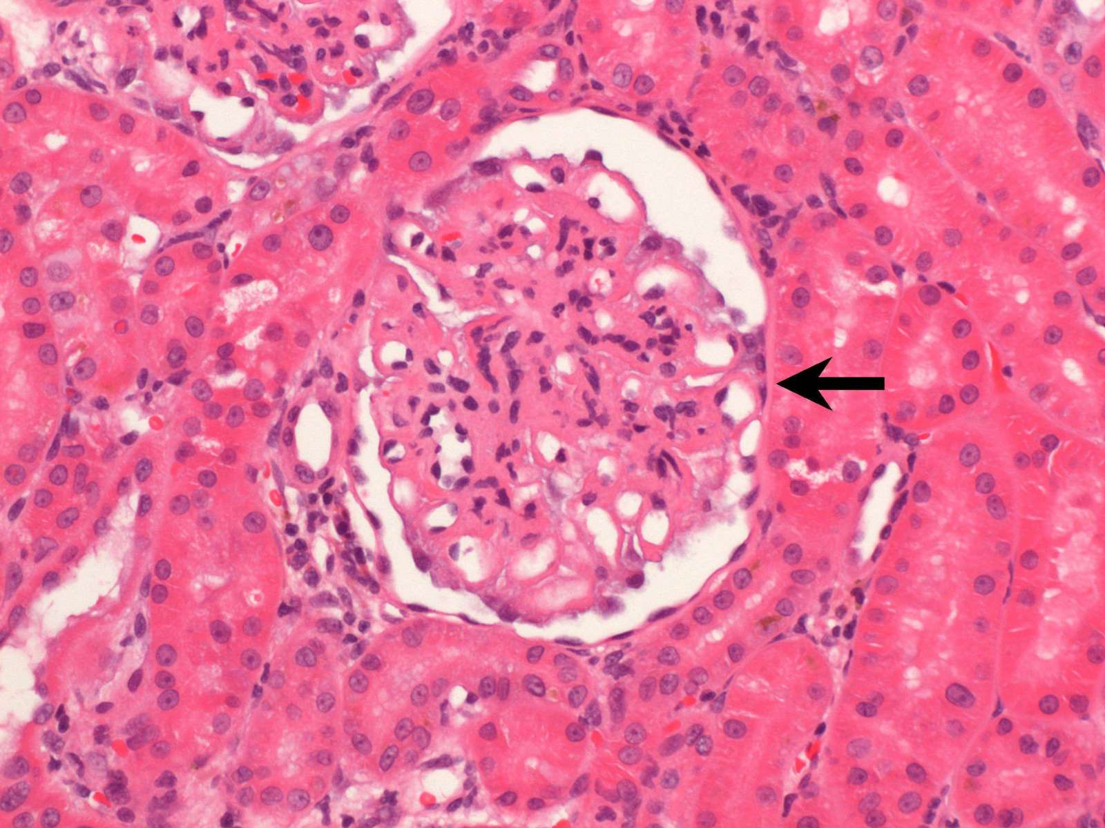 Glomerulonephritis in a dog Case Study Cytopath