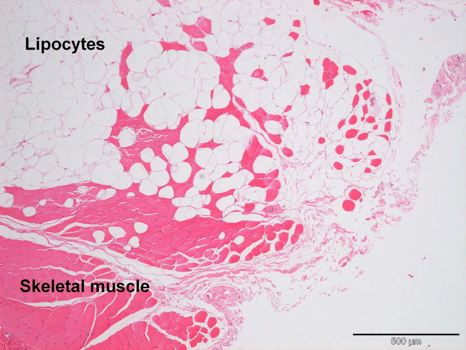 A cutaneous infiltrative lipoma in a 6yearold fe Case Study Cytopath