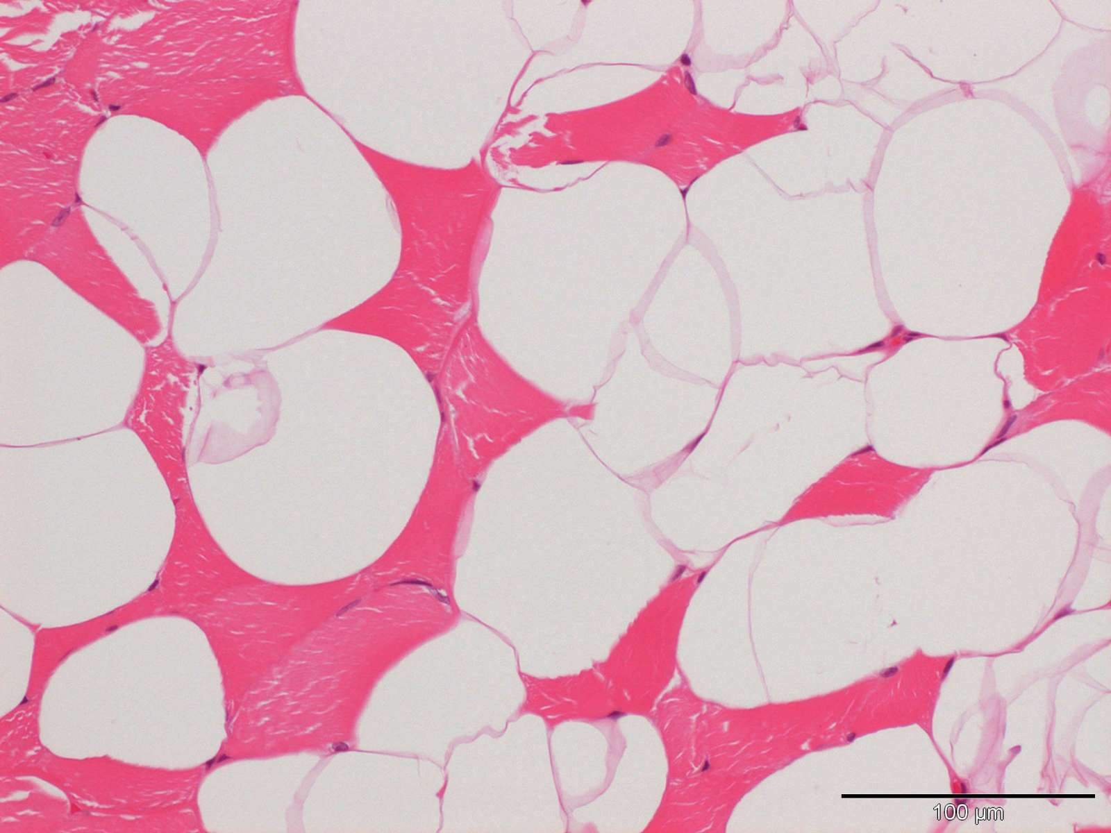A cutaneous infiltrative lipoma in a 6yearold fe Case Study Cytopath
