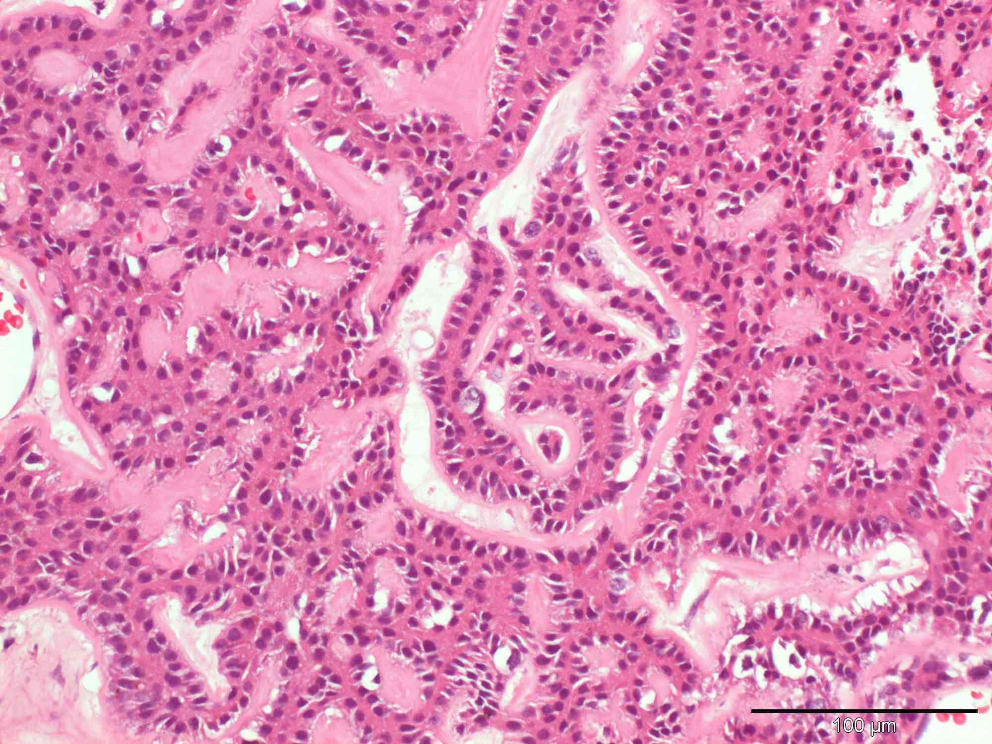 An iridociliary adenoma in a Labrador Retriever Case Study Cytopath