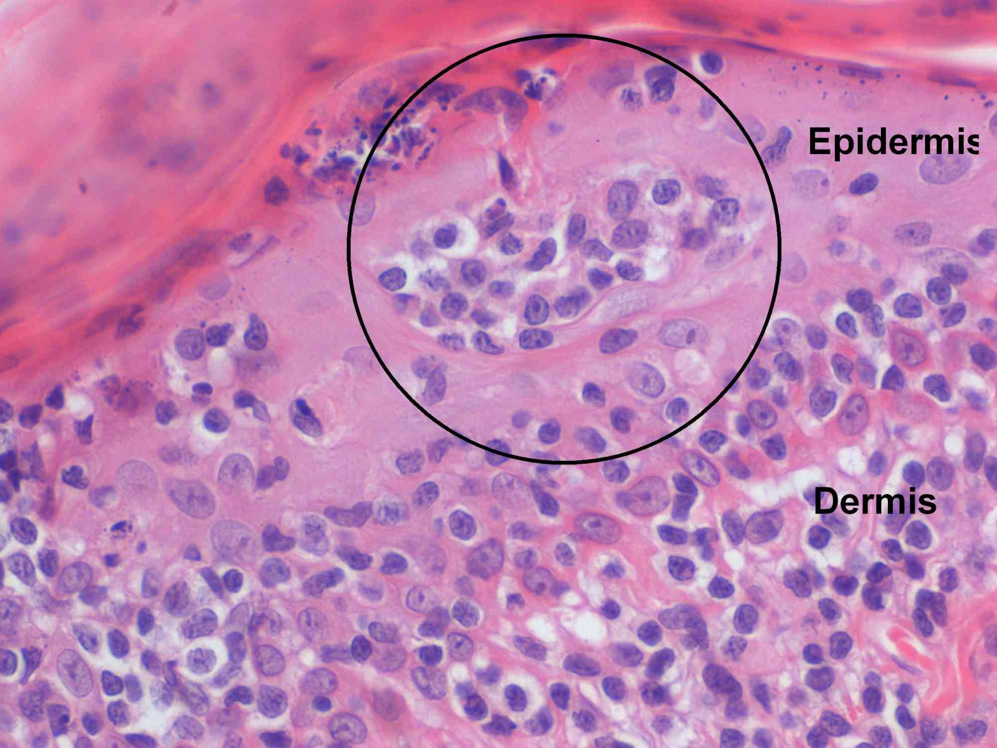 Cutaneous epitheliotropic lymphoma in a Cavalier K Case Study Cytopath