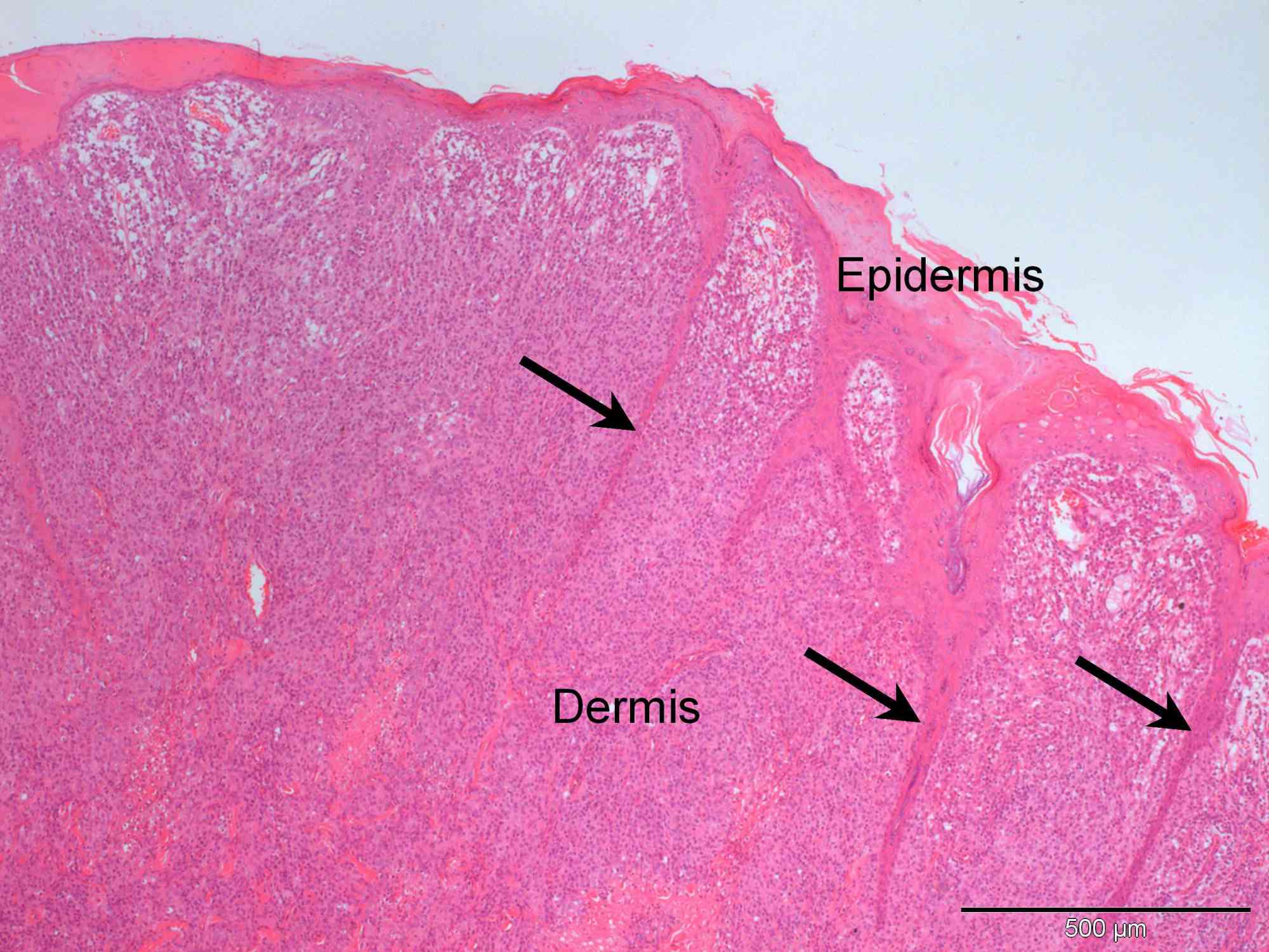 A benign cutaneous histiocytoma in a pug Case Study Cytopath