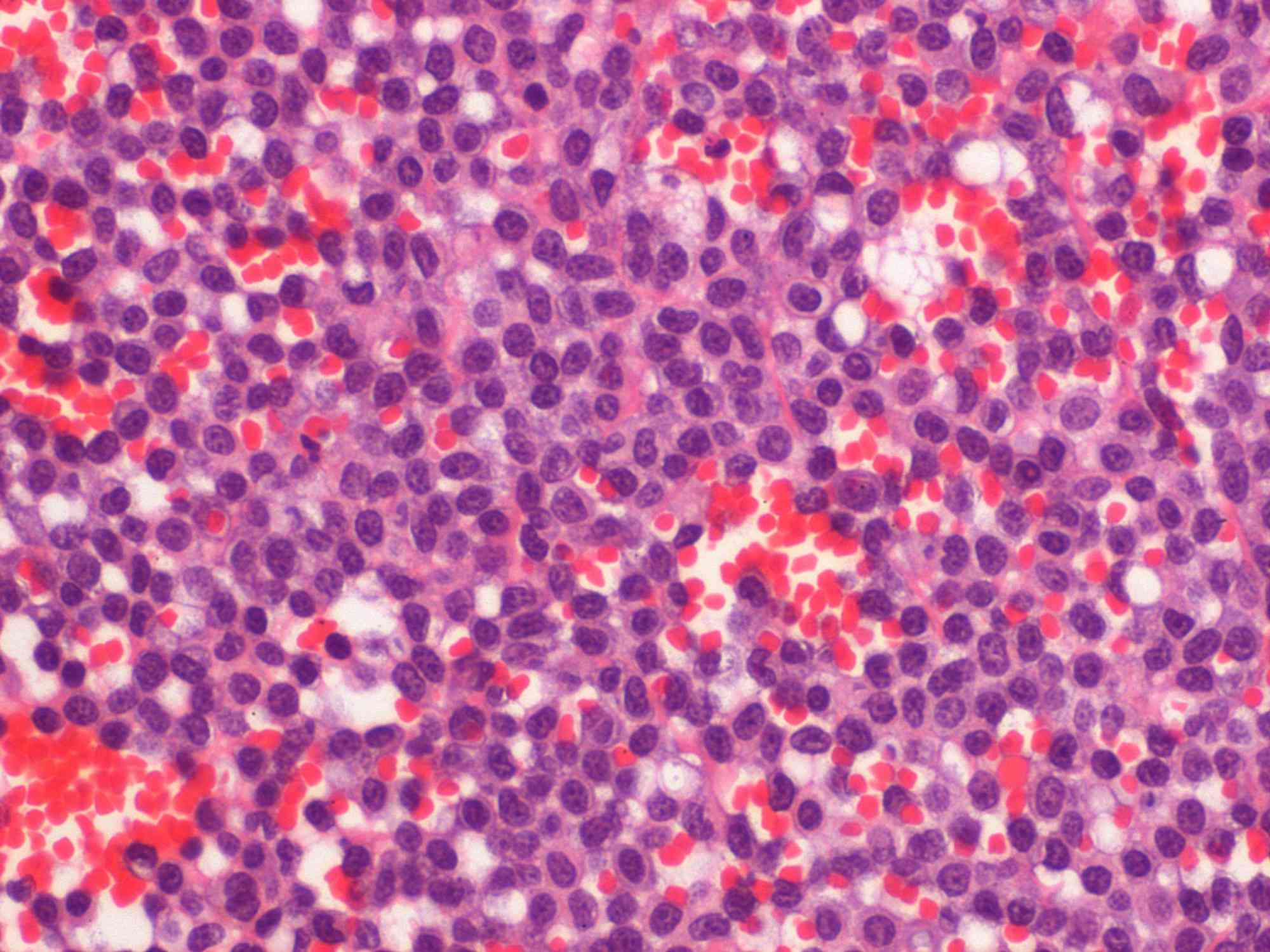 Splenic mast cell tumour in a cat Case Study Cytopath