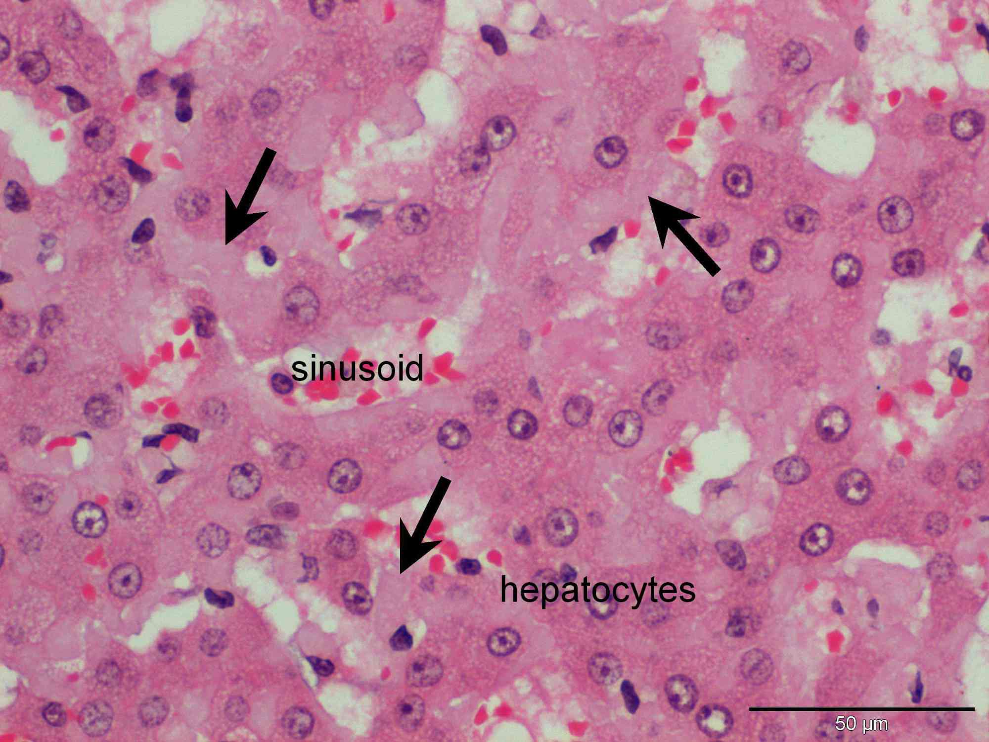 Hepatic amyloidosis in a cat Case Study Cytopath