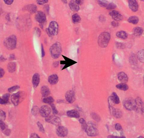 rhabdomyoma laryngeal cytopath striations