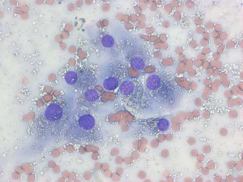 cytology leydig moderate tumour cytopath vacuoles neoplastic