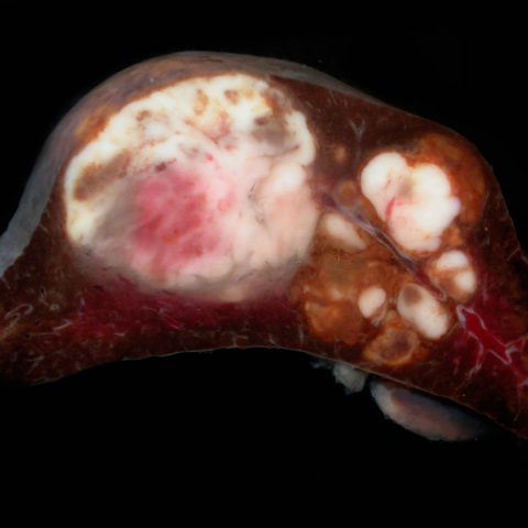 Spleen - Histiocytic sarcoma