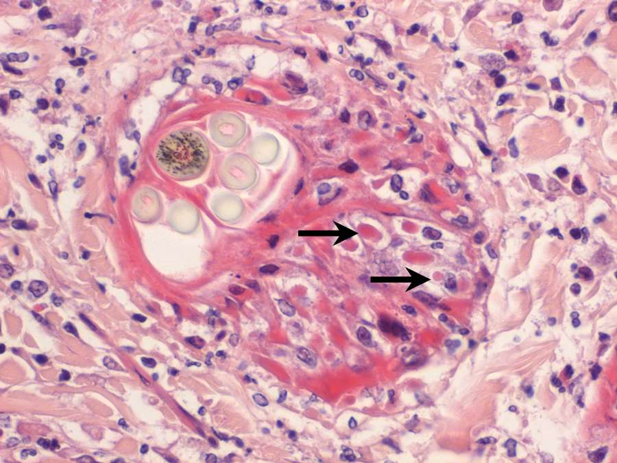 Cutaneous cowpox virus infection in a cat Case Study Cytopath
