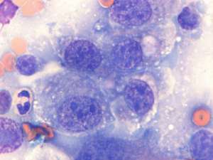 Transitional cell carcinoma (TCC) in a dog | Case Study | Cytopath