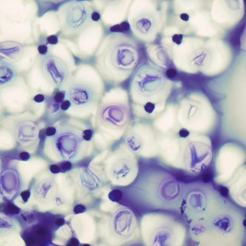 Cytology - Cryptococcus yeasts