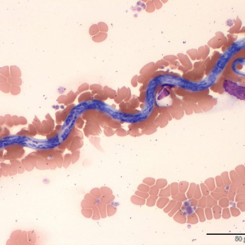Haematology - Peripheral blood - Microfilaria 