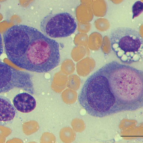 Cytology - Transitional cell carcinoma