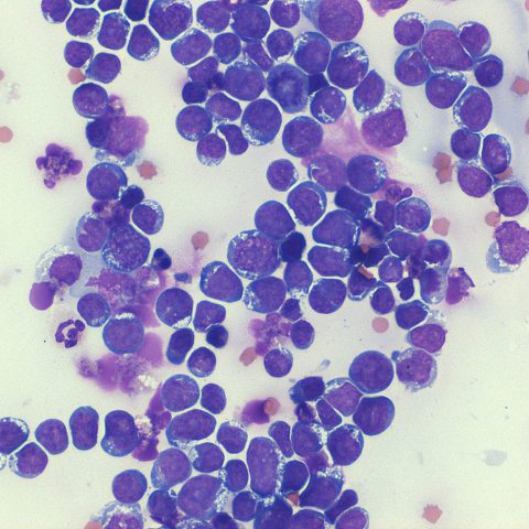 Cytology - Lymphoma 