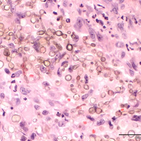 Histopathology - Phaeohyphomycosis
