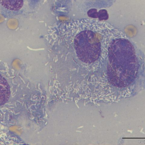 Cytology - Macrophages with intracytoplasmic mycobacteria