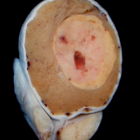 Testis -  Leydig (interstitial) cell tumour
