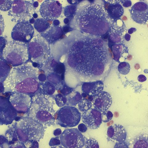 Cytology - Histiocytic sarcoma