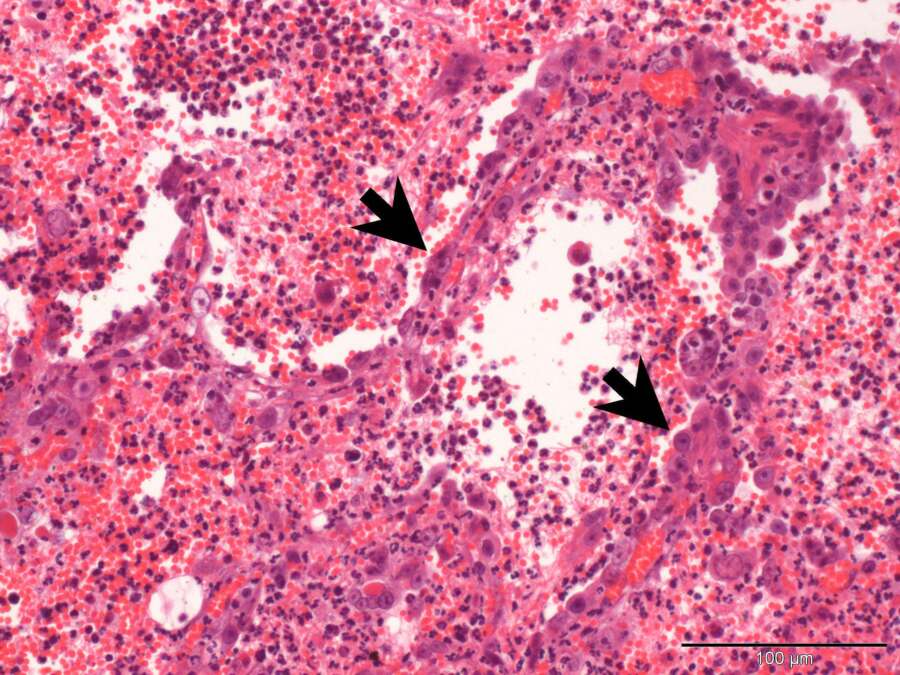 Autumn has arrived - fatal cowpox infection in a c | Case Study | Cytopath